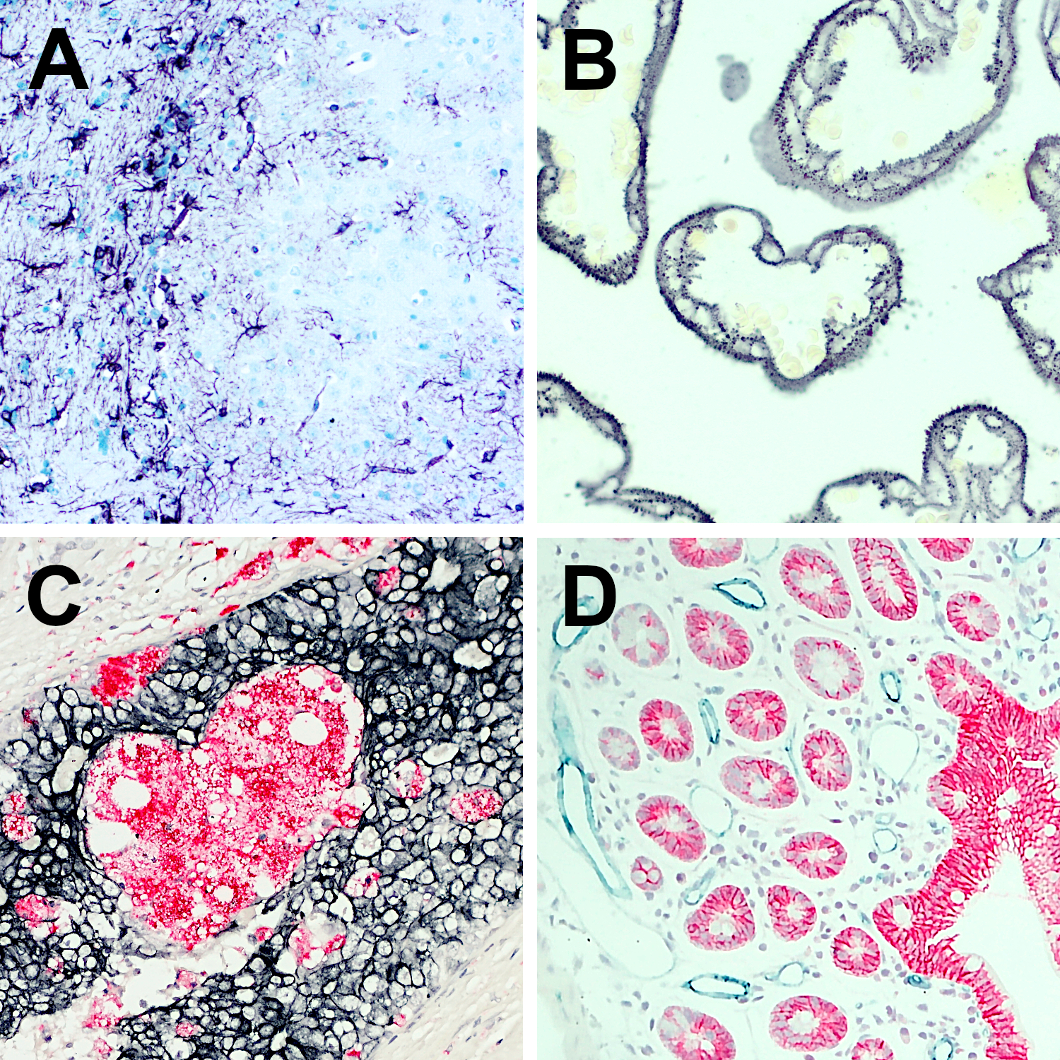 Chromogenic staining with different enzyme substrates for detection with HRP or AP. A: Indirect immunostaining of a formalin fixed paraffin embedded (FFPE) mouse brain section with mouse anti-GFAP (cat. no. 173 011, dilution 1:5000, Vector VIP HRP substrate, purple). Nuclei have been visualized by Methyl Green staining (light green). B: Indirect immunostaining of a formalin fixed paraffin embedded (FFPE) human placenta section with rat anti-Cytokeratin7 (cat. no. HS-454 017, dilution 1:200, TMB HRP substrate, black). No nuclear counterstain. C: Indirect immunostaining of a formalin fixed paraffin embedded (FFPE) human breast cancer section with rabbit anti-human CD68 (cat. no. HS-460 008, dilution 1:1000, Vector Red AP substrate, red) and rat anti-Cytokeratin7 (cat. no. HS-454 017, dilution 1:100, Vector SG HRP substrate, grey). Nuclei have been visualized by hematoxylin staining (blue). D: Indirect immunostaining of a formalin fixed paraffin embedded (FFPE) mouse duodenum section with rabbit anti-E-cadherin (cat. no. HS-467 003, dilution 1:100, Vector Red AP substrate, red) and rat anti-CD31 (cat. no. HS-351 117, dilution 1:1000, HistoGreen HRP substrate, green). Nuclei have been visualized by hematoxylin staining (blue).