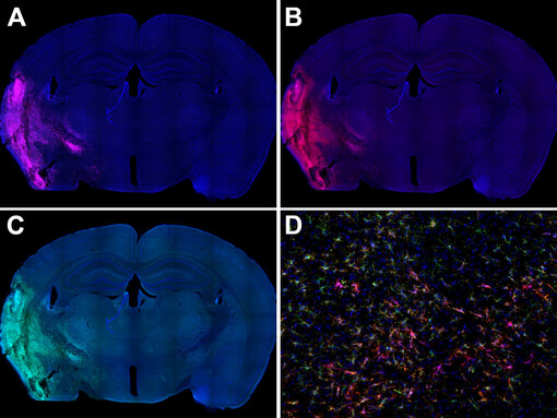 Activated microglia in the lesion area of a mouse stroke brain highly express Galectin-3 (pink), CD11b (red) and IBA1 (green)