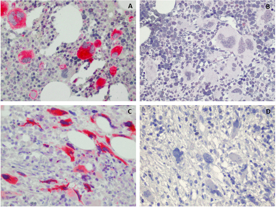 <b>A</b> and <b>C</b>: Selective staining of mutated CALR protein in megakaryocytes of two PMF cases, respectively in prefibrotic phase and in fibrotic phase, in which Sanger sequencing detected a CALR mutation.<br><b>B</b> and <b>D</b>: Absent CAL2 staining in two PMF cases, respectively in prefibrotic and in fibrotic phase, both without molecularly detected mutated CALR. The fibrotic stroma remains unstained (<b>C</b> and <b>D</b>).<br>​